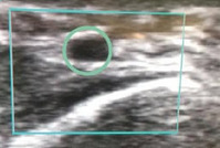 Ultrasound probe over a vessel