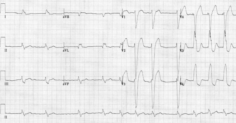 LBBB ECG