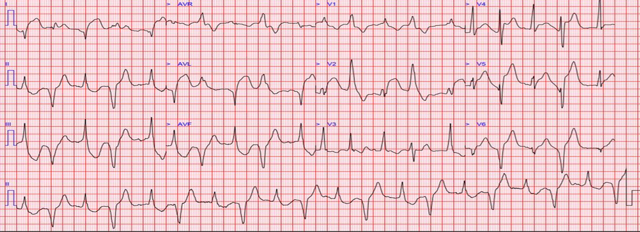 Bifascicular block ECG, nicknamed the South African flag sign