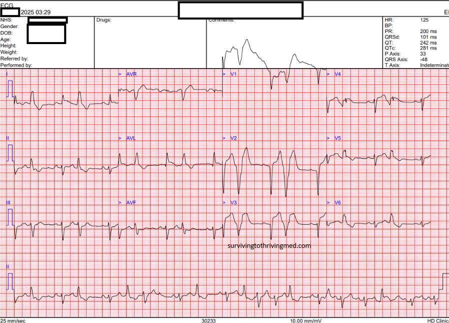 Anterior STEMI ECG