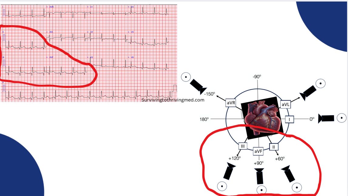 Inferior STEMI ECG
