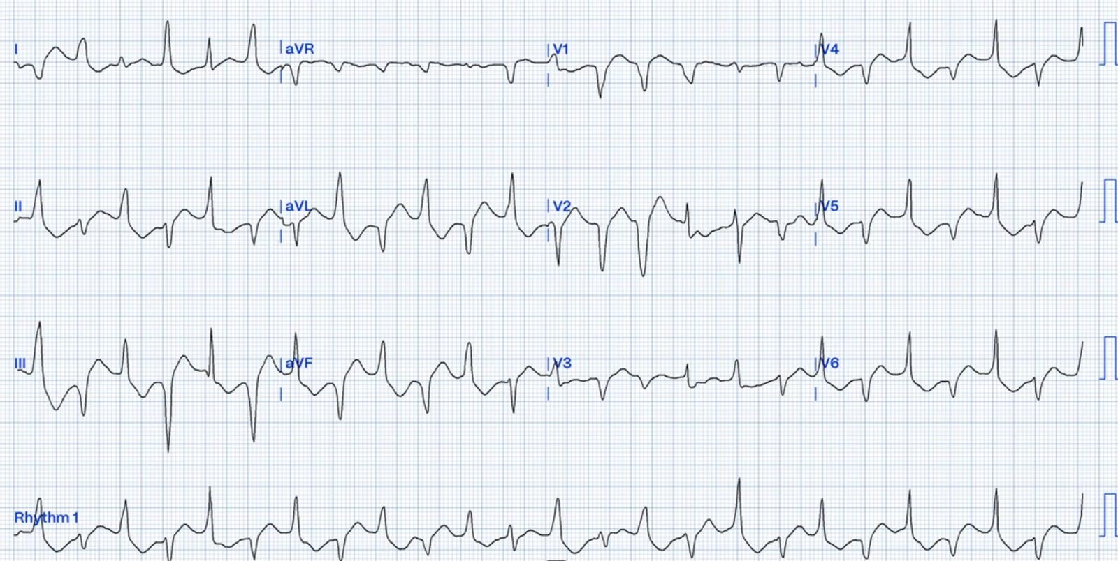 Bidirectional VT ECG