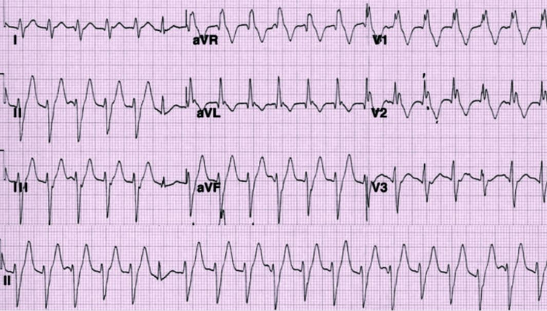 Fascicular VT ECG
