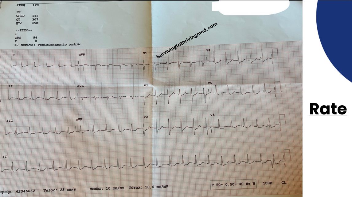 ECG rate calculation worked example
