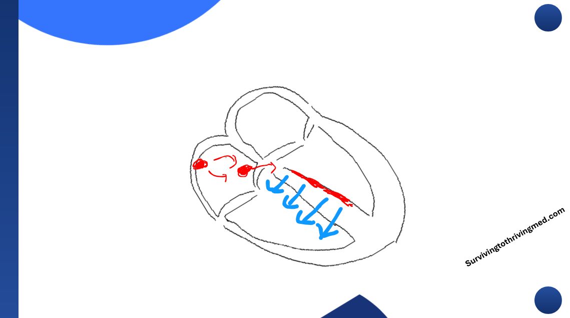 Q wave morphology diagram