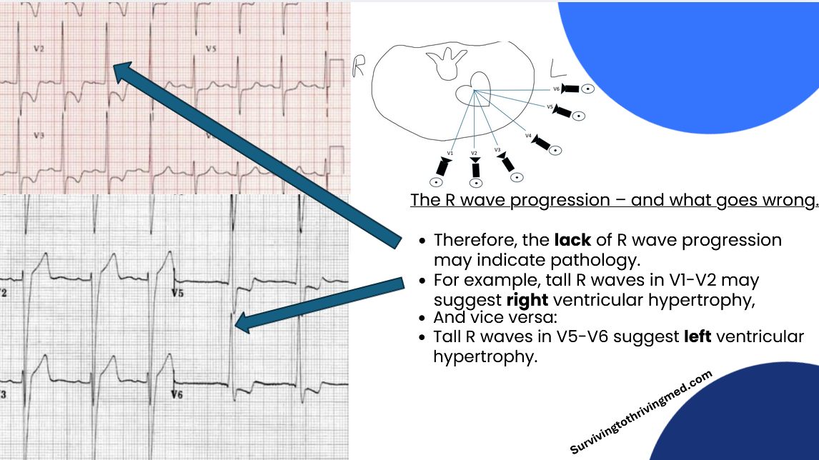R wave progression diagram