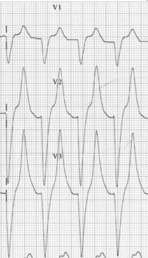 Tall tented T waves on ECG