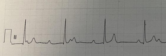 Complete heart block ECG rhythm strip
