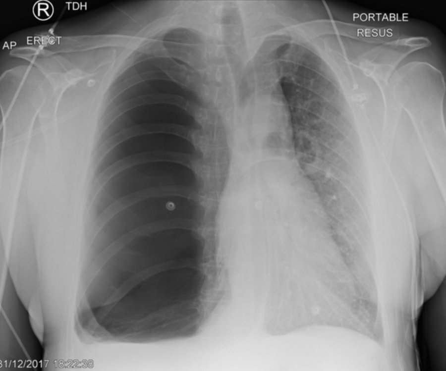 A portable AP chest X-ray